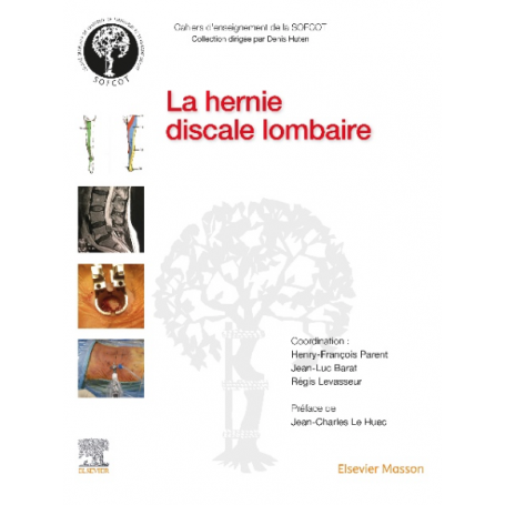 La hernie discale lombaire