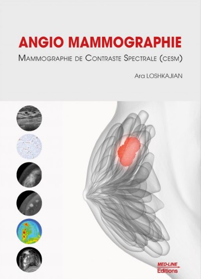 Angio-mammographie, mammographie de contraste spectrale