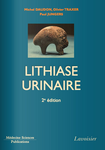 Lithiase urinaire