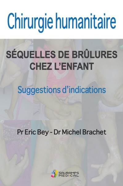 Chirurgie humanitaire : séquelles de brûlures chez l'enfant