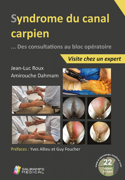 Syndrome du canal carpien