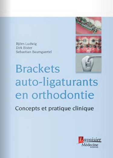 Brackets auto-ligaturants en orthodontie