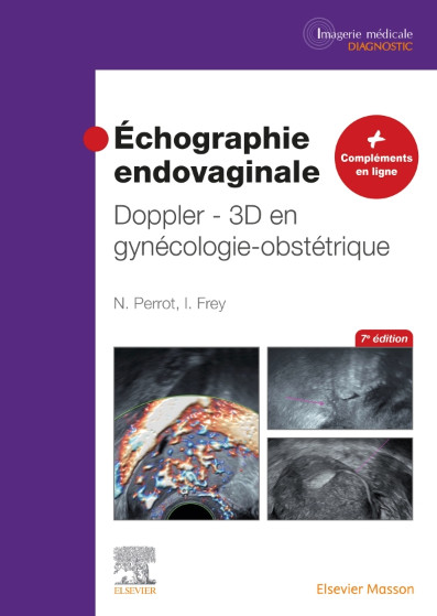 Echographie endovaginale, doppler 3D