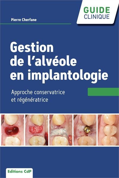 Gestion de l'alvéole en implantologie