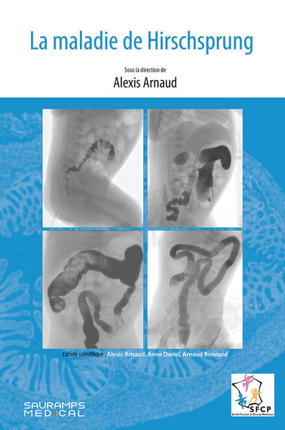 La maladie de Hirschsprung