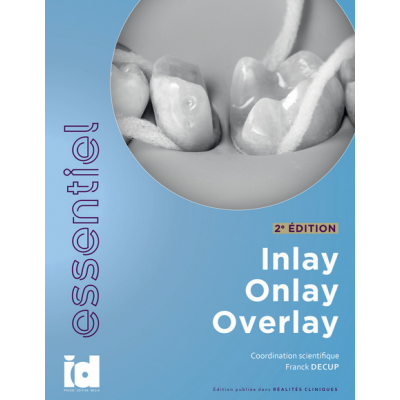 Inlay, onlay, overlay