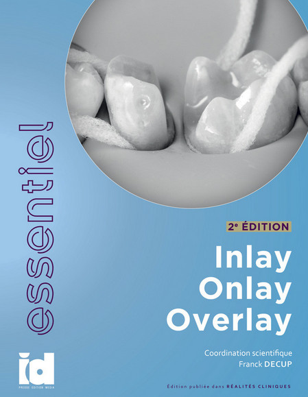 Inlay, onlay, overlay