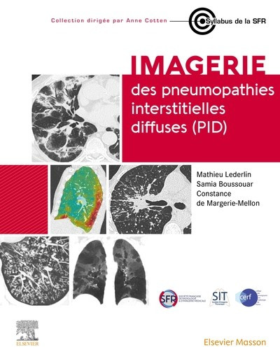 Imagerie des pneumopathies interstitielles diffuses