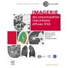 Imagerie des pneumopathies interstitielles diffuses