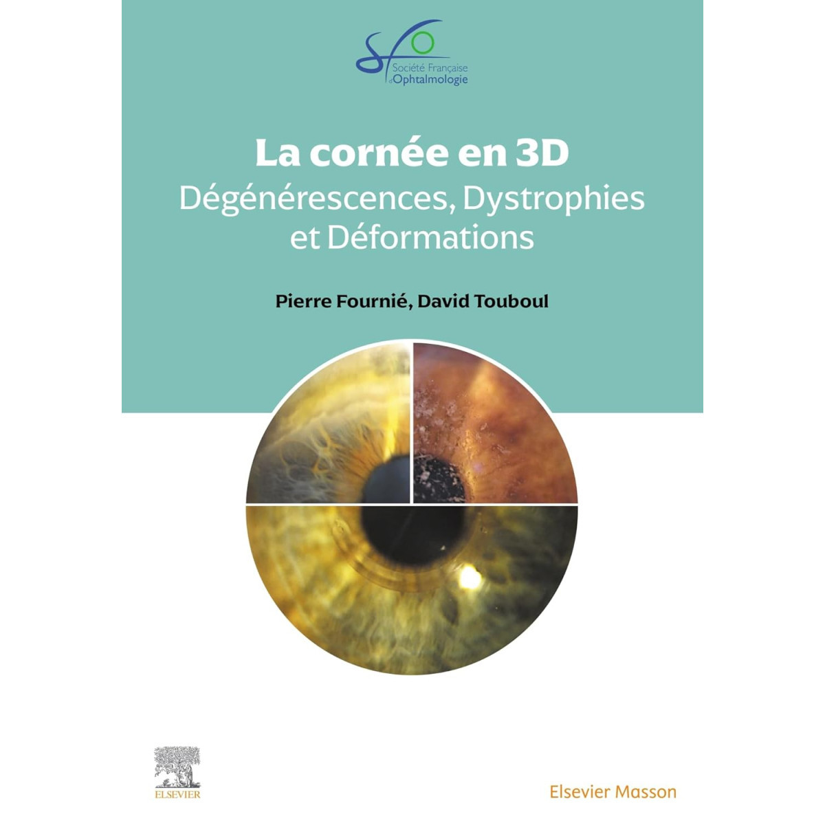 La cornée en 3D - Dégénérescences, dystrophies et déformations