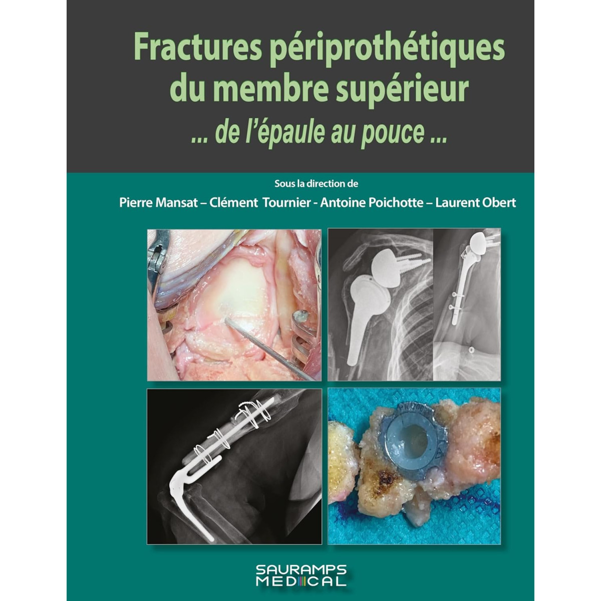 Fractures périprothétiques du membre supérieur... de l'épaule au pouce...