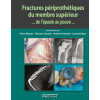 Fractures périprothétiques du membre supérieur... de l'épaule au pouce...