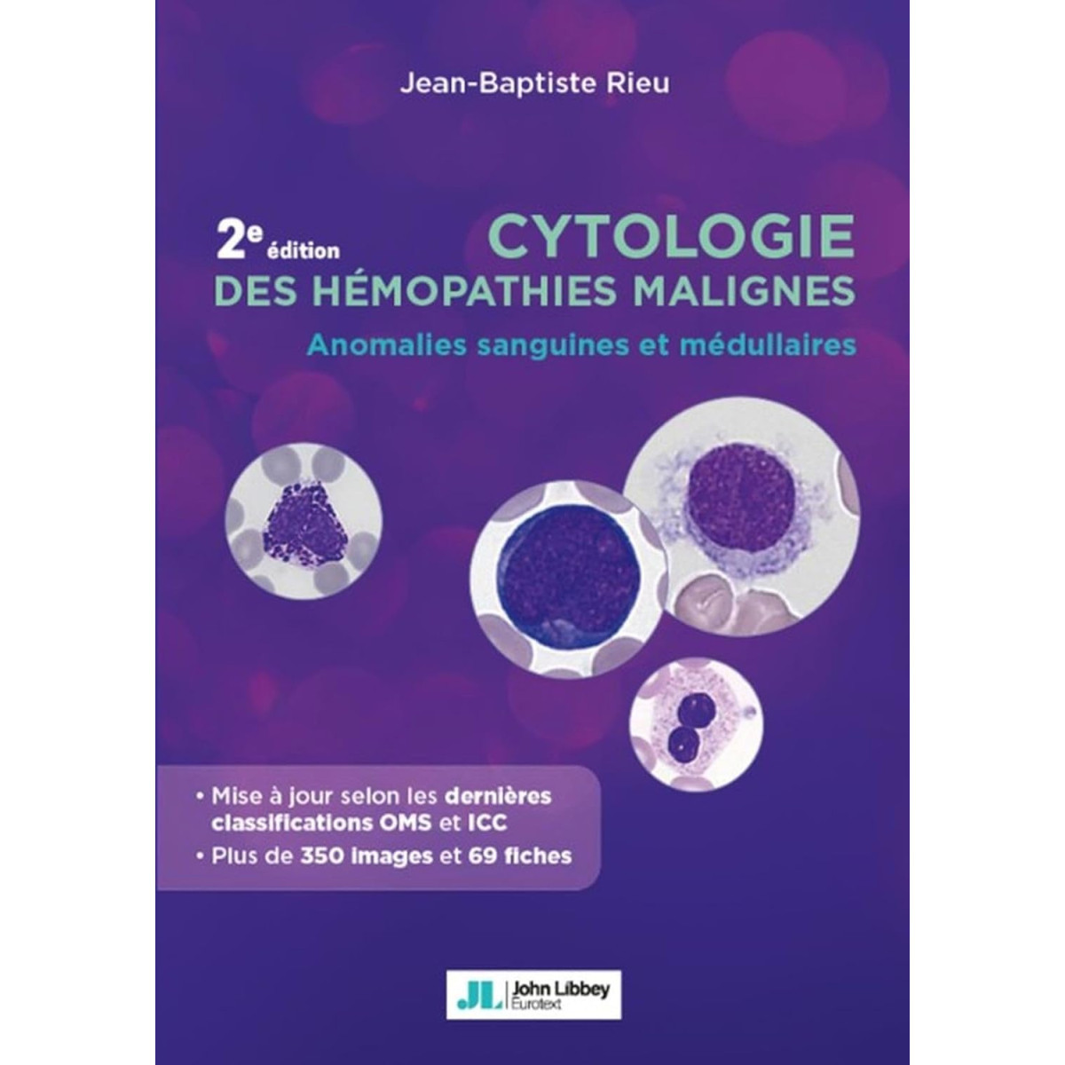 Cytologie des hémopathies malignes - Anomalies sanguines et médullaires