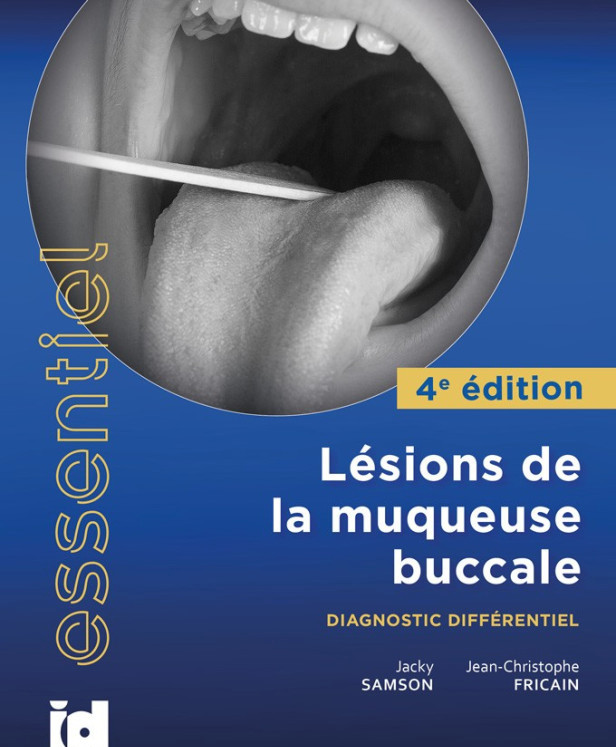 Lésions de la muqueuse buccale - Diagnostic différentiel