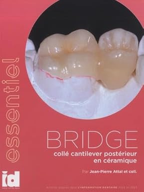 Bridge collé cantilever postérieur en céramique