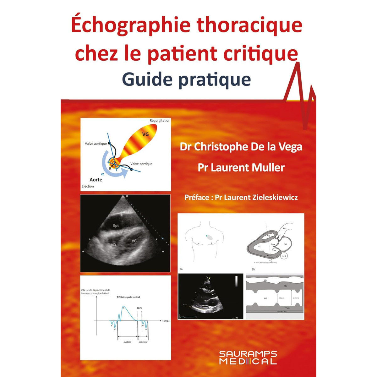 Échographie thoracique chez le patient critique - Guide pratique