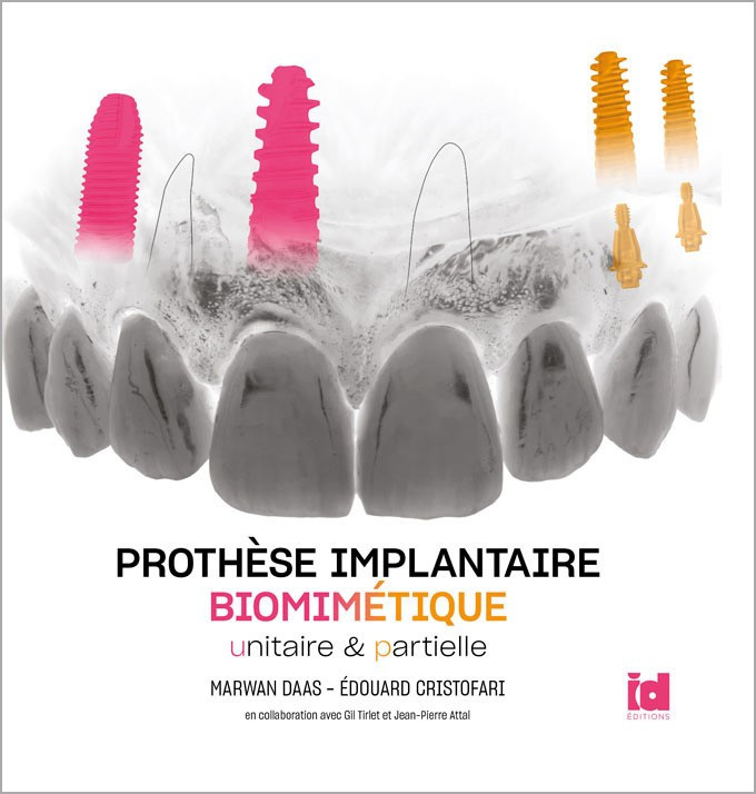 Prothèse implantaire biomimétique unitaire et partielle
