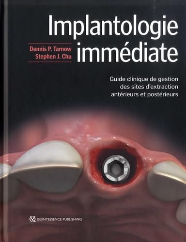 Implantologie immédiate - Guide clinique de gestion des sites d'extraction antérieurs et postérieurs