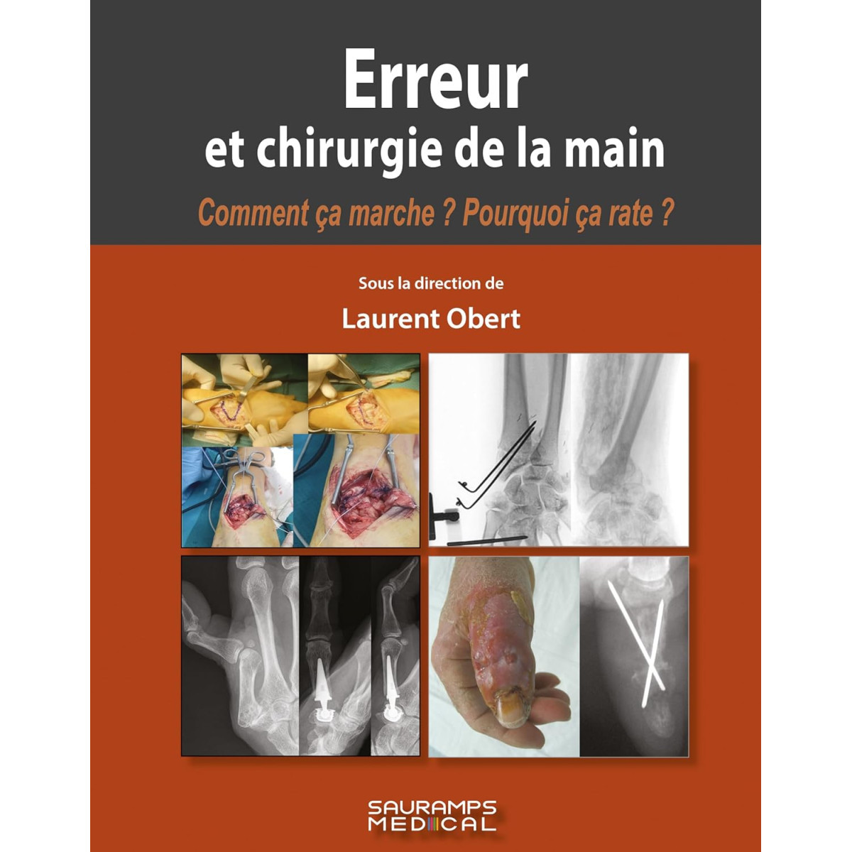 Erreur et Chirurgie de la main - Comment ça marche ? Pourquoi ça rate ?