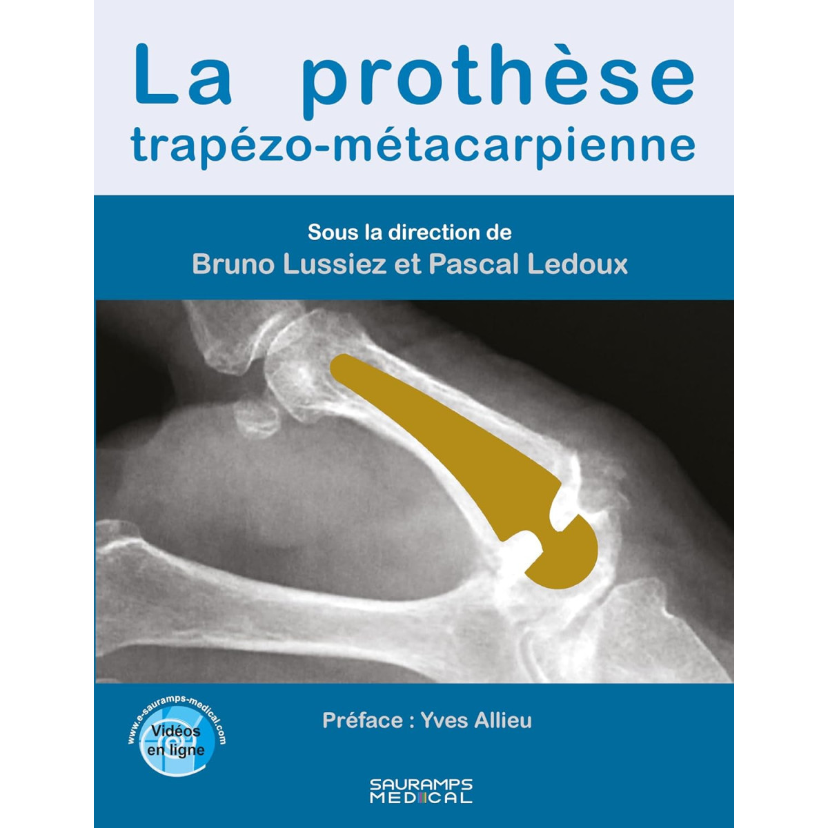 La prothèse trapézo-métacarpienne