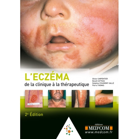 L'eczéma