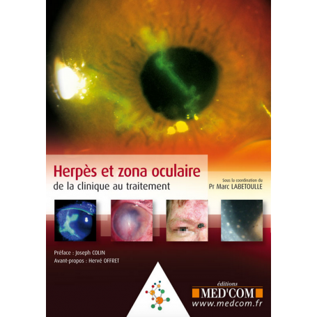 Herpès et zona oculaire