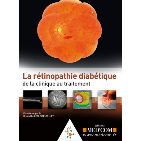 La rétinopathie diabétique