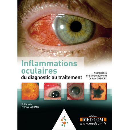 Inflammations oculaires