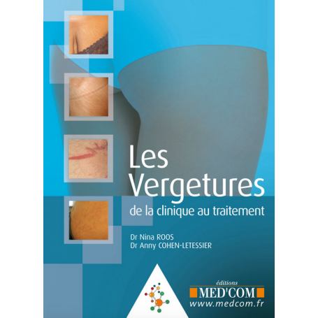 Les vergetures