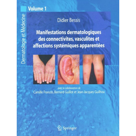 Manifestations dermatologiques des connectivites, vasculites et affections systémiques apparentées