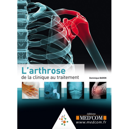 L'arthrose : de la clinique au traitement