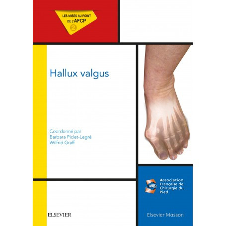 Hallux valgus