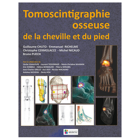 Tomoscintigraphie osseuse de la cheville et du pied