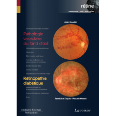 Pathologie vasculaire du fond d'oeil, rétinopathie diabétique