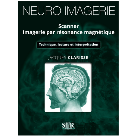 Neuro-imagerie : scanner, imagerie par résonance magnétique