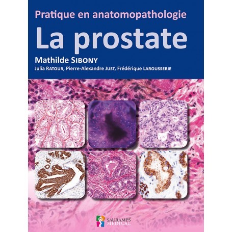La prostate : pratique en anatomopathologie